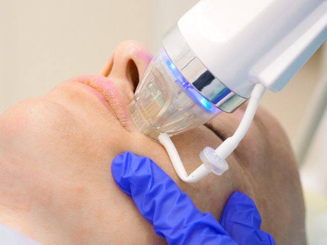 microneedling